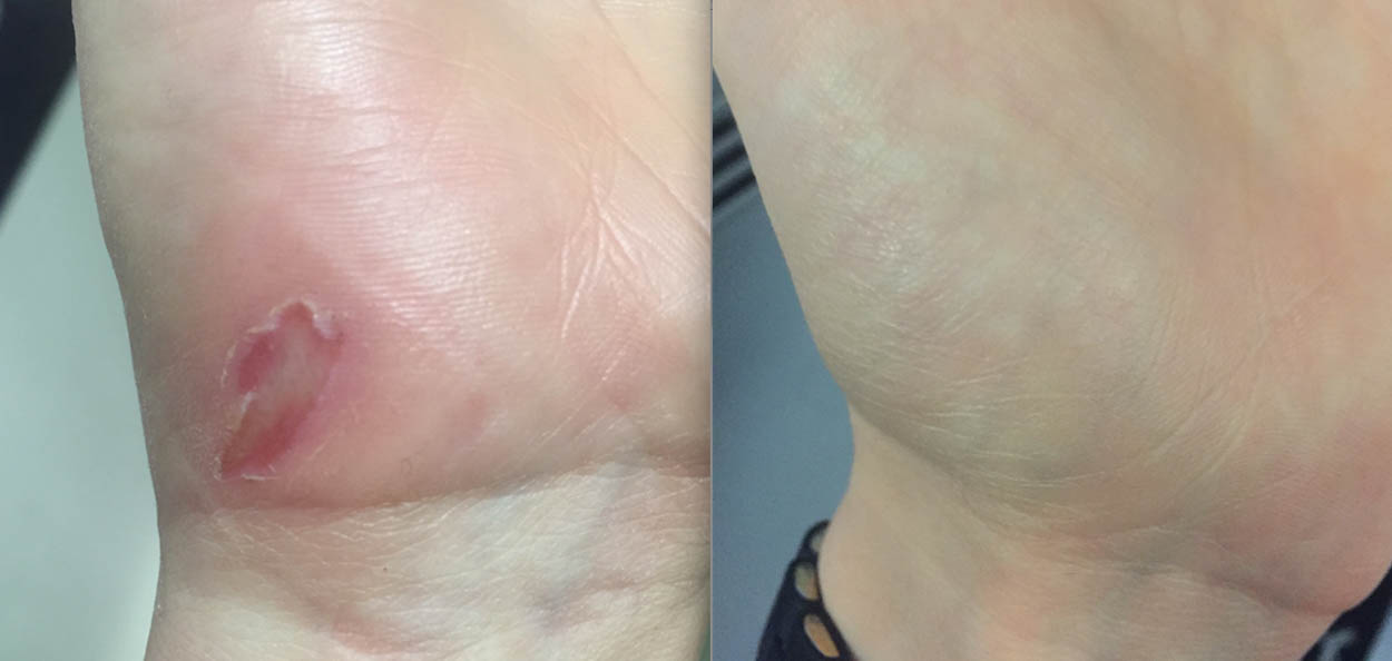 Wound healing - The slightly different beauty tips - ID14238_00.jpg?v=1566310428