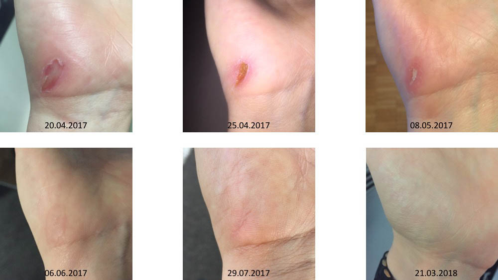 Wound healing - The slightly different beauty tips - ID14238_02.jpg?v=1566310428